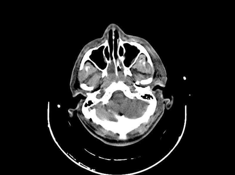 File:Brain injury by firearm projectile (Radiopaedia 82068-96087 B 52).jpg
