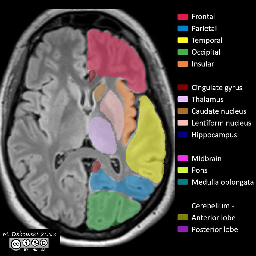 Brain lobes - annotated MRI (Radiopaedia 61691-69700 Axial 37).JPG