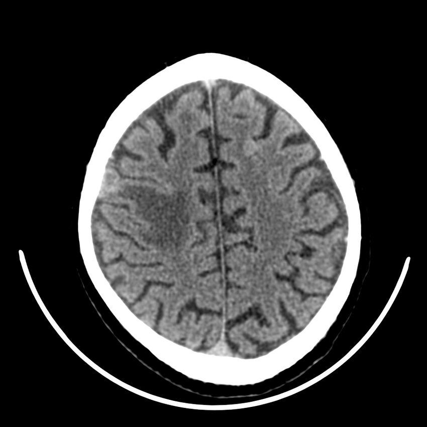 Brain metastasis (Radiopaedia 42617-45760 Axial non-contrast 37).jpg