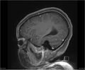 Brainstem glioma (Radiopaedia 21819-21775 D 33).jpg