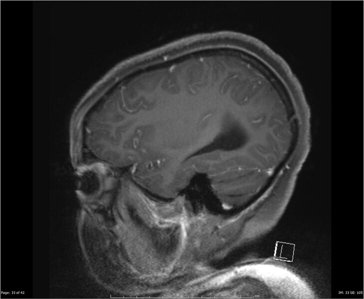 File:Brainstem glioma (Radiopaedia 21819-21775 D 33).jpg