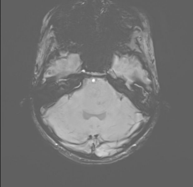 File:Brainstem glioma (Radiopaedia 70548-80674 Axial SWI 12).jpg