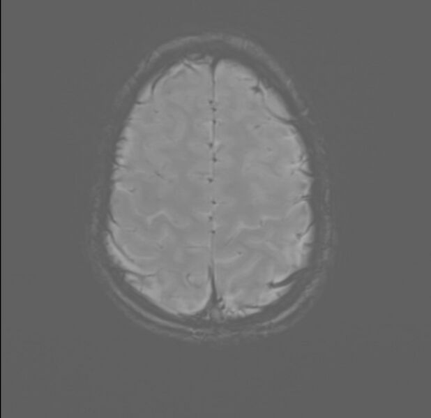 File:Brainstem glioma (Radiopaedia 70548-80674 Axial SWI 54).jpg