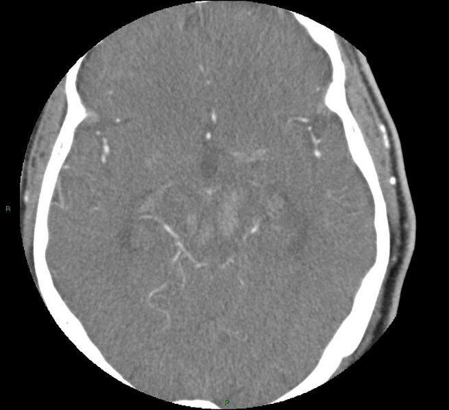 File:Brainstem hemorrhage (Radiopaedia 58794-66028 D 84).jpg