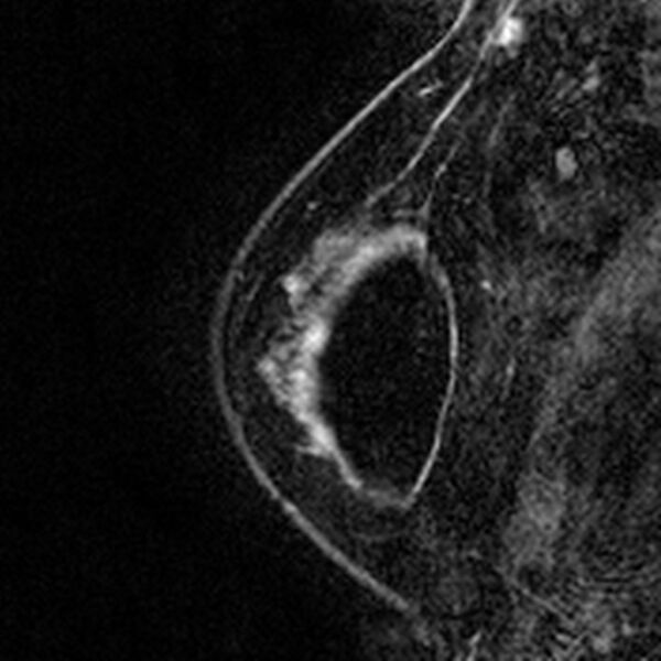 File:Breast implants - MRI (Radiopaedia 26864-27035 Sagittal T2 12).jpg