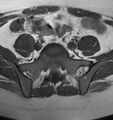 Broad ligament leiomyoma (Radiopaedia 81634-95516 Axial T1 1).jpg