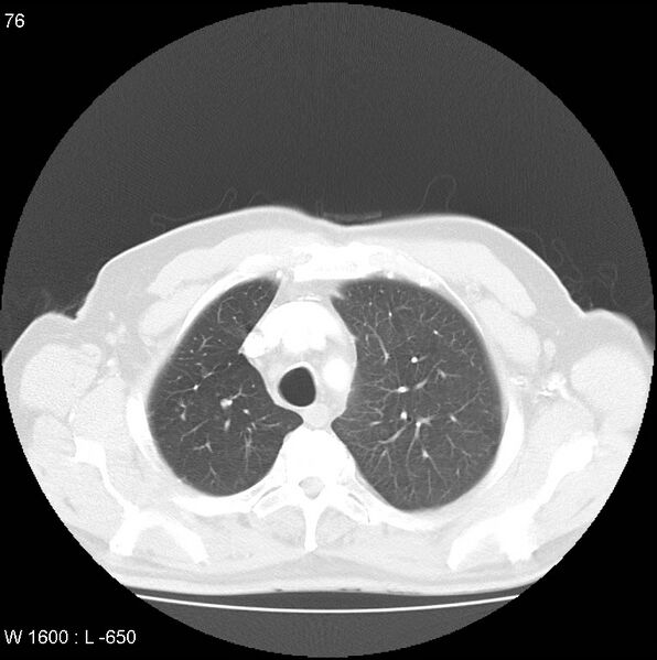 File:Bronchial carcinoid tumor with right lower lobe collapse (Radiopaedia 29060-29422 B 14).jpg
