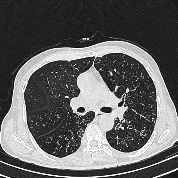 File:Bronchiectasis (Radiopaedia 22061-22059 lung window 14).jpg