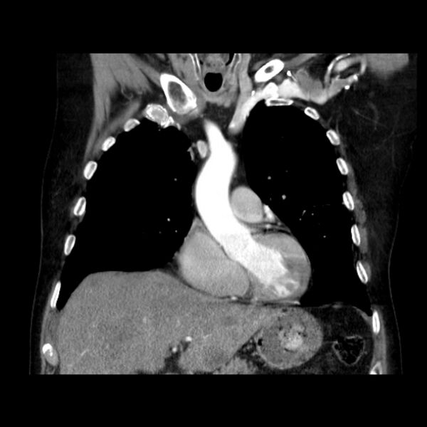 File:Bronchogenic adenocarcinoma and pulmonary embolism (Radiopaedia 9097-9806 C 17).jpg