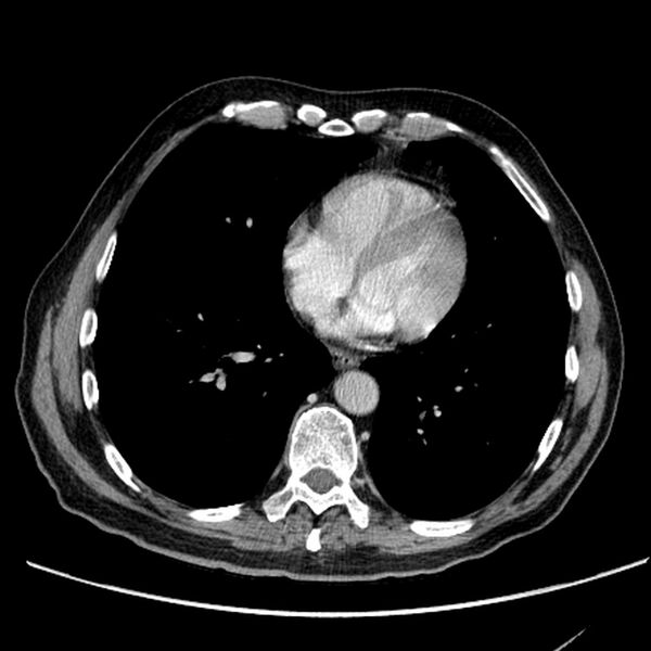 File:Bronchogenic carcinoma with L1 vertebra metastasis (Radiopaedia 9096-9805 Axial C+ delayed 23).jpg