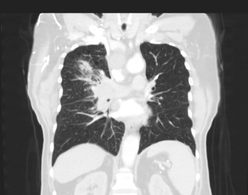 Bronchogenic carcinoma with lymphangitic spread (Radiopaedia 29002-29357 Coronal lung window 37).jpg