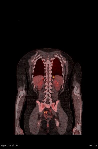 File:Brown fat uptake (FDG PET-CT) (Radiopaedia 77392-89513 Fused coronal 76).jpg
