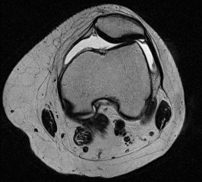 File:Bucket handle tear - medial meniscus (Radiopaedia 79028-91942 Axial T2 20).jpg