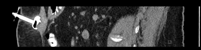 File:Buried bumper syndrome - gastrostomy tube (Radiopaedia 63843-72575 Sagittal Inject 51).jpg