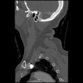 C1 anterior arch (plough) fracture - type 1 (Radiopaedia 76181-87720 Sagittal bone window 19).jpg