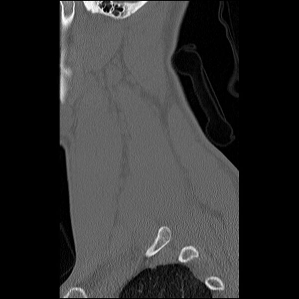 File:C5 facet fracture (Radiopaedia 58374-65499 Sagittal bone window 14).jpg