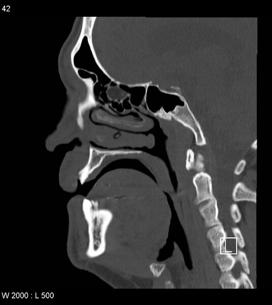 File:Calcification of the transverse band of the cruciform ligament (Radiopaedia 53063-59025 Sagittal bone window 19).jpg