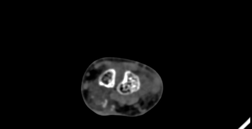 Calcifying aponeurotic fibroma (Radiopaedia 88423-105064 B 55).jpg