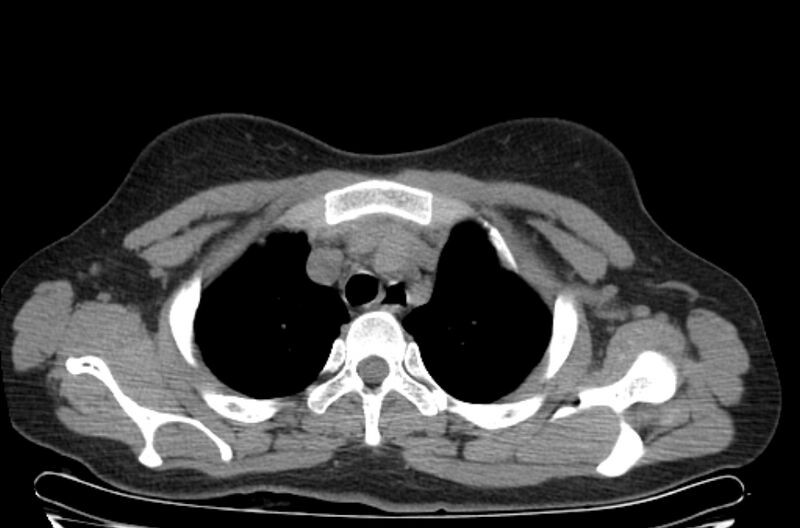 File:Cannonball metastases - uterine choriocarcinoma (Radiopaedia 70137-80173 Axial non-contrast 14).jpg