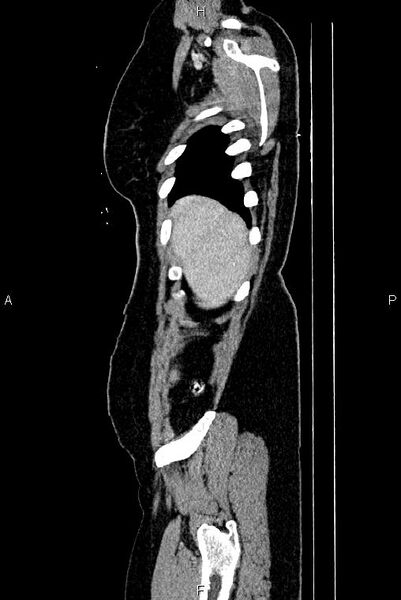 File:Carcinoma of uterine cervix (Radiopaedia 85861-101700 D 3).jpg