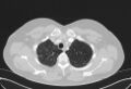 Cardiac sarcoidosis (Radiopaedia 74548-85534 Axial lung window 14).jpg