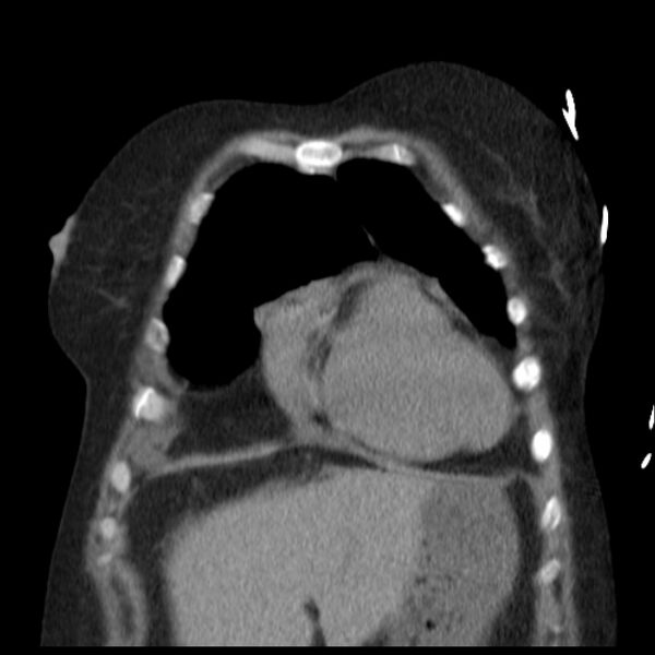 File:Cardiogenic pulmonary edema (Radiopaedia 29213-29609 Coronal non-contrast 7).jpg