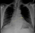 Cardiomegaly with left atrium enlargement (Radiopaedia 84873-100367 C 1).PNG