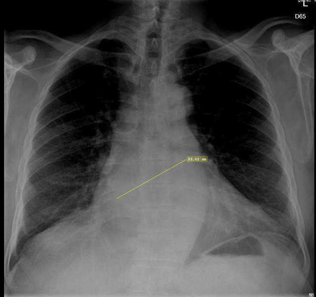 File:Cardiomegaly with left atrium enlargement (Radiopaedia 84873-100367 C 1).PNG