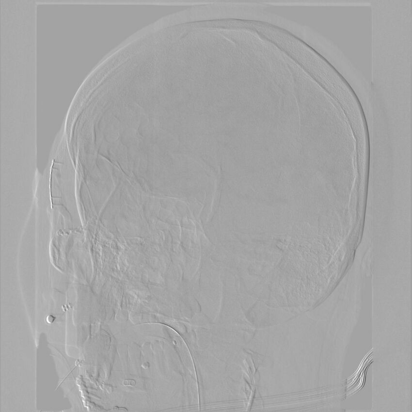 Caroticocavernous fistula - direct (Radiopaedia 61660-69666 Oblique Left ICA 44).jpg