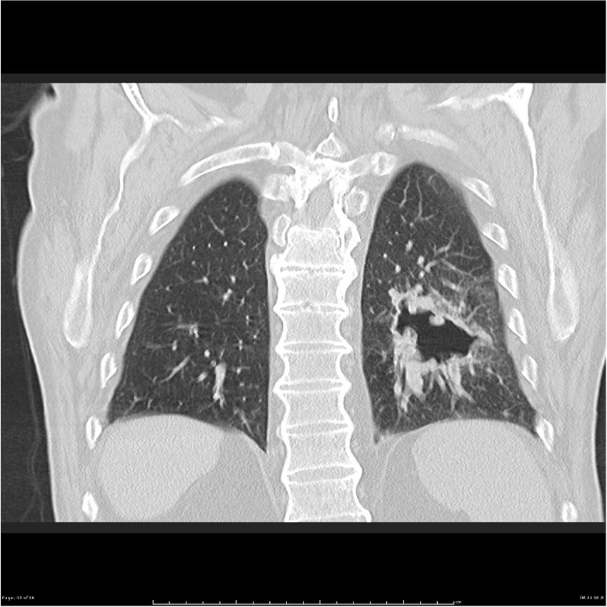 Cavitating left lower lobe lesion - squamous cell lung cancer (Radiopaedia 27749-28176 Coronal lung window 43).jpg