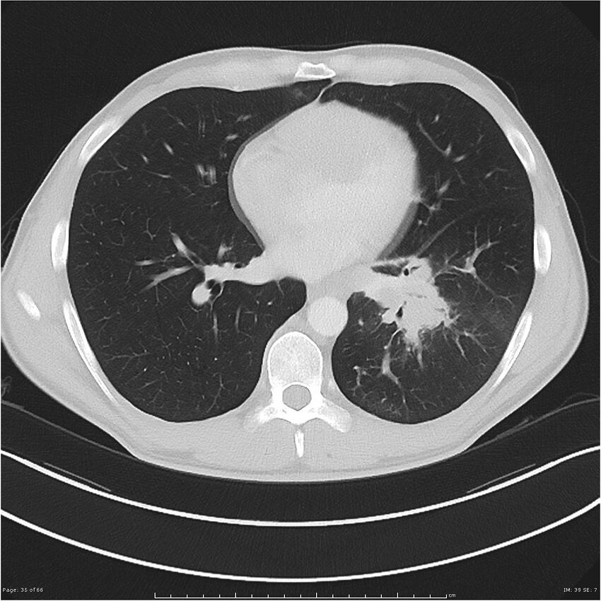 Cavitating lung cancer (Radiopaedia 25796-25945 Axial lung window 35).jpg