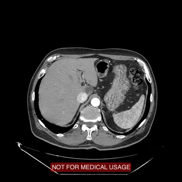 File:Celiac trunk variant anatomy - gastrohepatic trunk and splenic artery (Radiopaedia 38815-40995 A 2).jpg