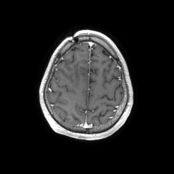File:Central neurocytoma (Radiopaedia 67618-77021 Axial T1 C+ 25).jpg