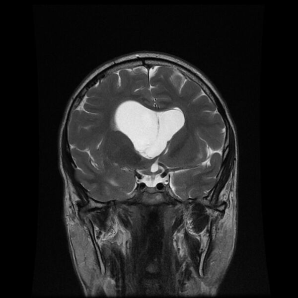 File:Central neurocytoma (Radiopaedia 67618-77021 Coronal T2 8).jpg