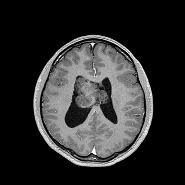 File:Central neurocytoma (Radiopaedia 79320-92380 Axial T1 C+ 156).jpg