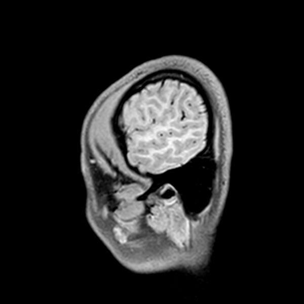 File:Central neurocytoma (Radiopaedia 79320-92380 Sagittal T1 232).jpg
