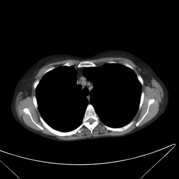 File:Centrilobular pulmonary emphysema (Radiopaedia 24495-24789 Axial non-contrast 13).jpg