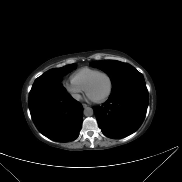 File:Centrilobular pulmonary emphysema (Radiopaedia 24495-24789 Axial non-contrast 34).jpg