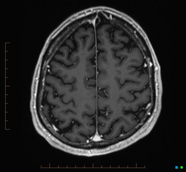 File:Cerebellar gangliocytoma (Radiopaedia 65377-74422 Axial T1 C+ 110).jpg