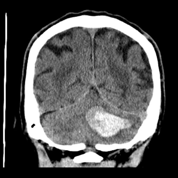 File:Cerebellar hemorrhage (Radiopaedia 27193-27359 Coronal non-contrast 44).jpg