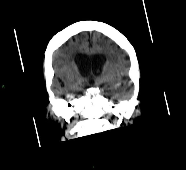 File:Cerebellar hemorrhage (Radiopaedia 58792-66026 Coronal non-contrast 38).jpg