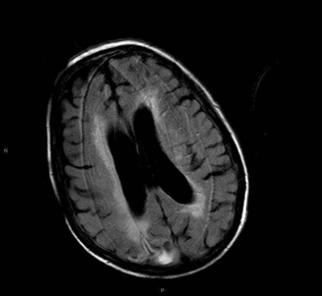 File:Cerebral amyloid angiopathy-associated lobar intracerebral hemorrhage (Radiopaedia 58377-65515 Axial FLAIR 11).jpg