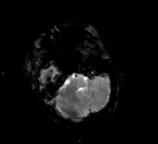 File:Cerebral amyloid angiopathy-associated lobar intracerebral hemorrhage (Radiopaedia 58377-65515 Axial Gradient Echo 20).jpg
