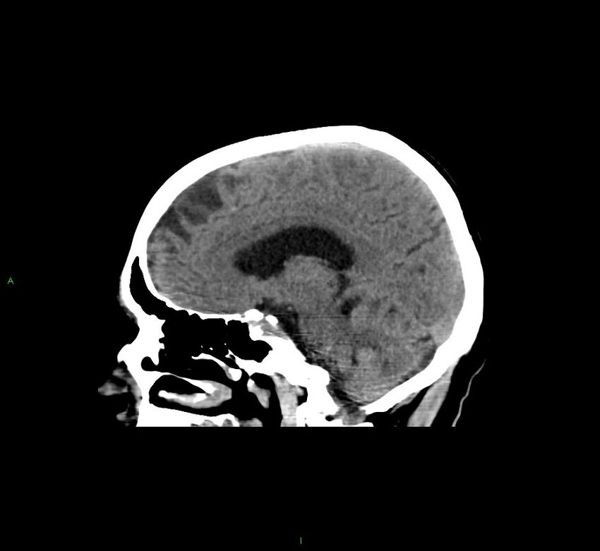 Cerebral amyloid angiopathy-associated lobar intracerebral hemorrhage (Radiopaedia 58529-65681 B 22).jpg