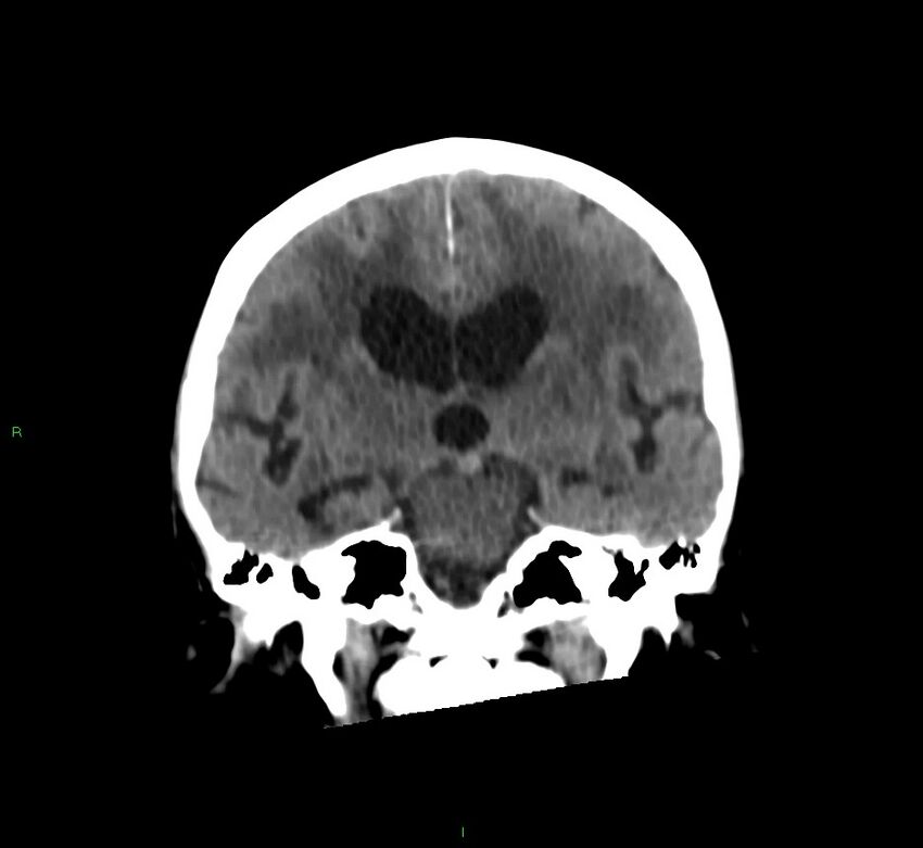 Cerebral amyloid angiopathy-associated lobar intracerebral hemorrhage (Radiopaedia 58530-65688 Coronal non-contrast 36).jpg