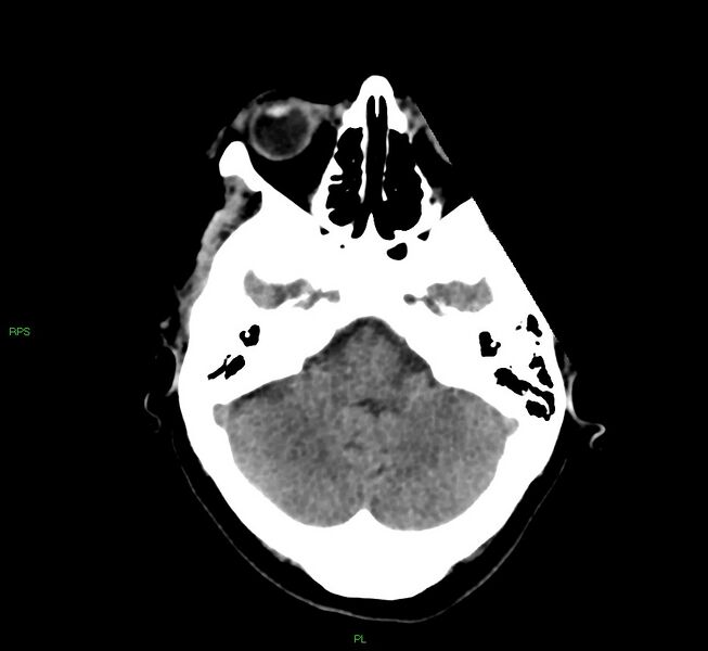 File:Cerebral amyloid angiopathy-associated lobar intracerebral hemorrhage (Radiopaedia 58569-65734 Axial non-contrast 46).jpg