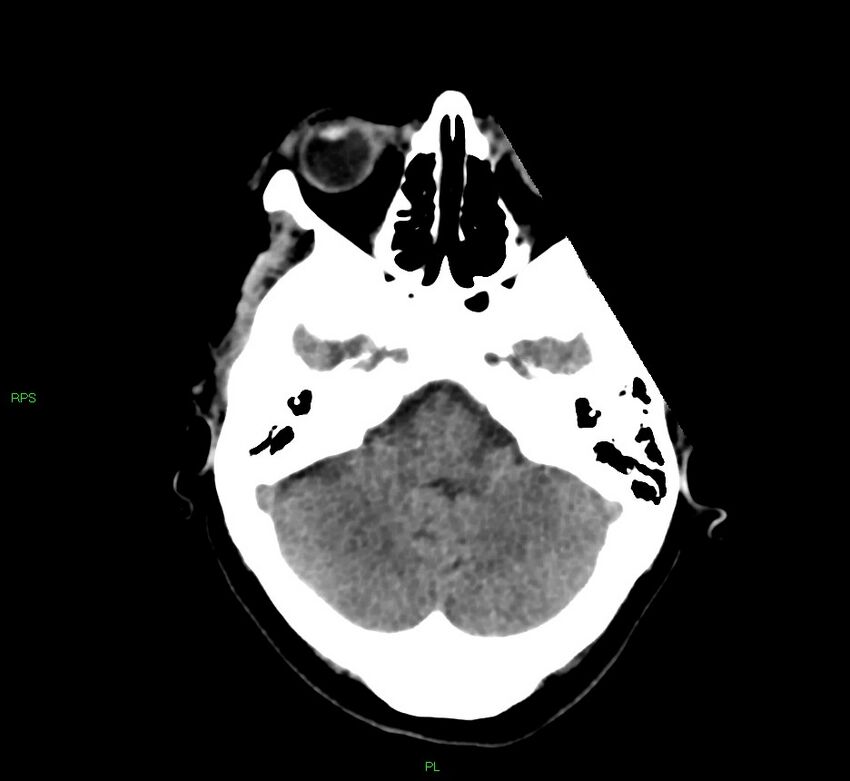 Cerebral amyloid angiopathy-associated lobar intracerebral hemorrhage (Radiopaedia 58569-65734 Axial non-contrast 46).jpg