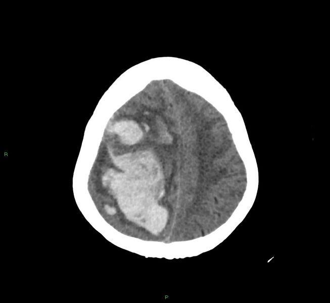 File:Cerebral amyloid angiopathy-associated lobar intracerebral hemorrhage (Radiopaedia 58751-65972 Axial non-contrast 14).jpg