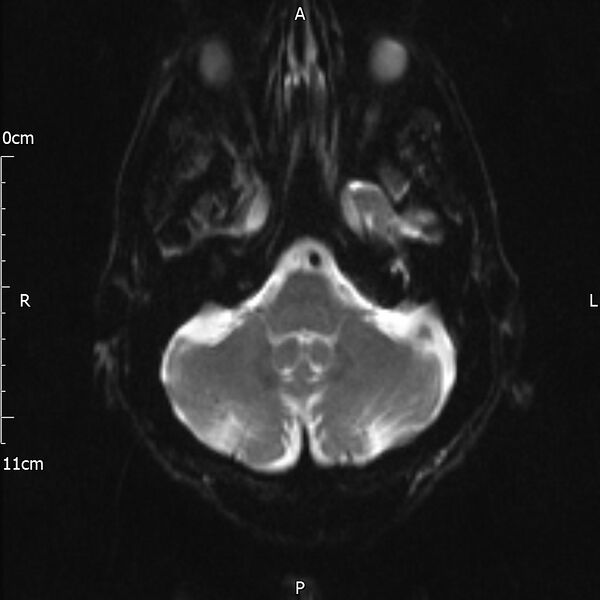 File:Cerebral amyloid angiopathy related inflammation (Radiopaedia 72772-83415 Axial DWI 6).jpg