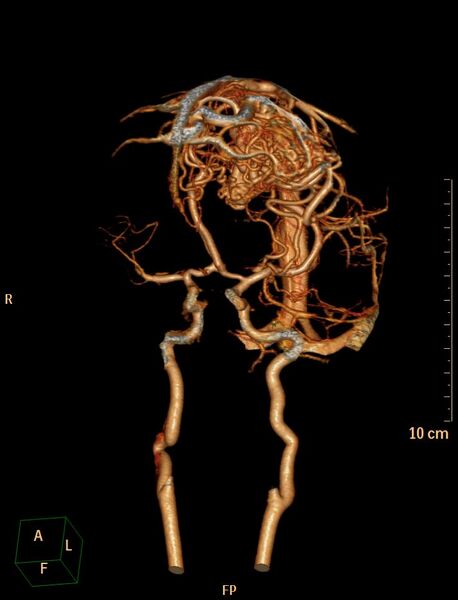 File:Cerebral arteriovenous malformation (Radiopaedia 29531-30031 B 20).jpg
